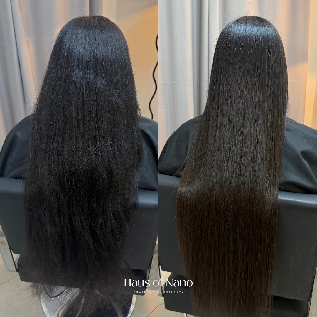 Before and after nanoplasty treatment 1