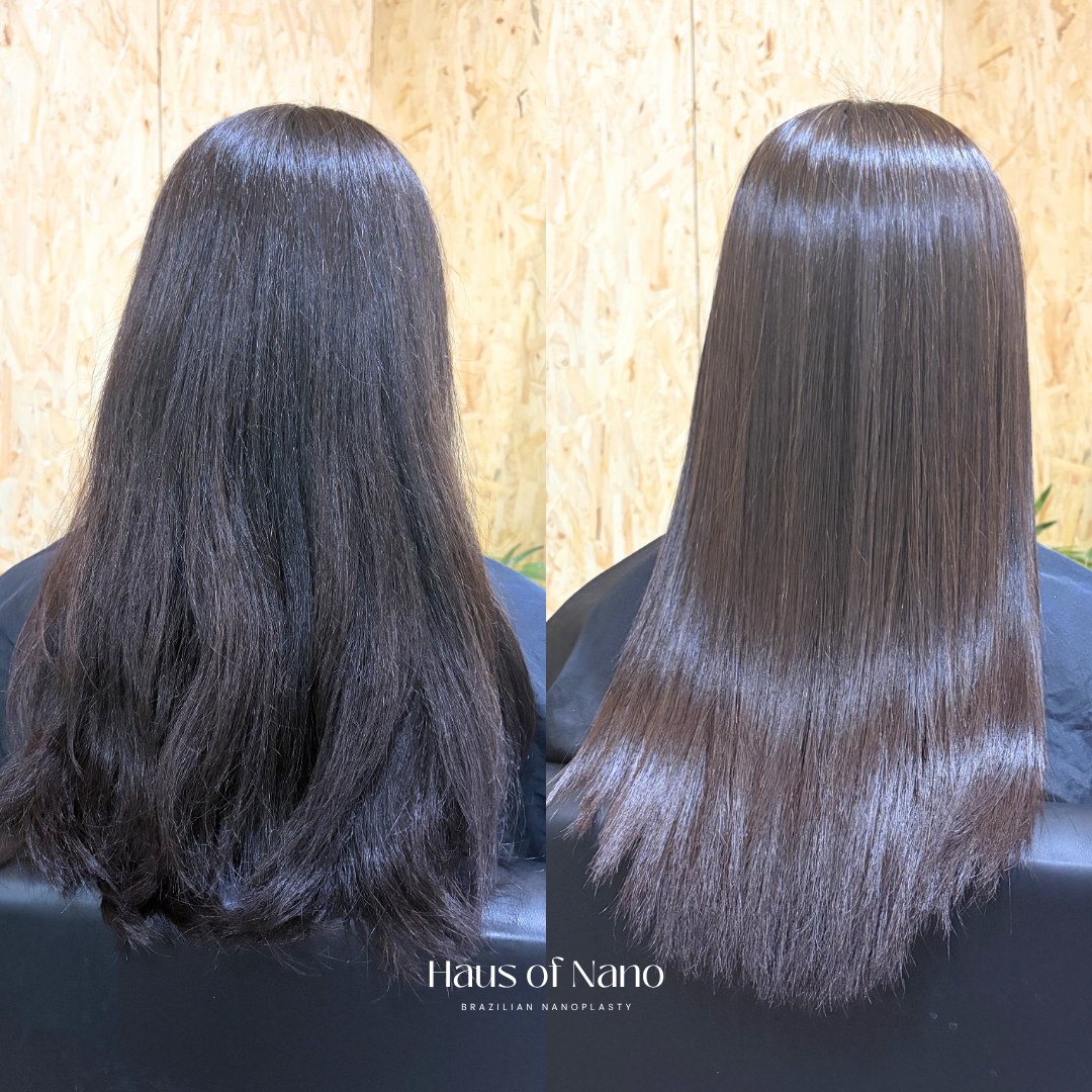 Before and after nanoplasty treatment 10