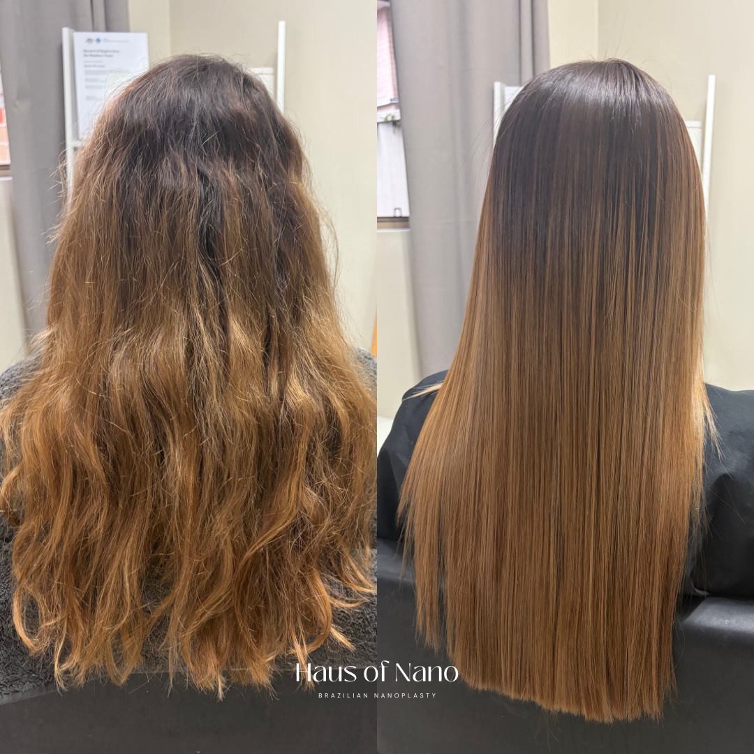 Before and after nanoplasty treatment 11