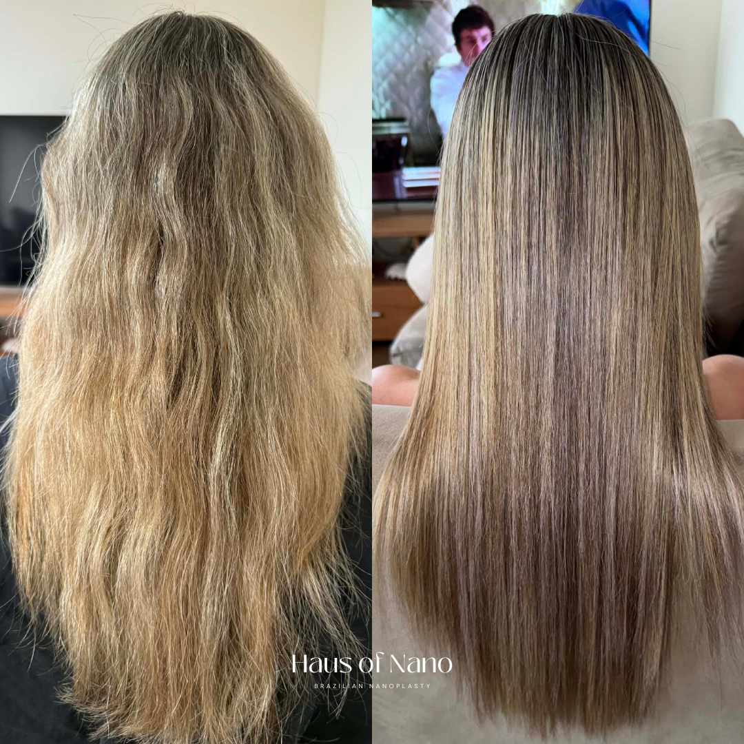Before and after nanoplasty treatment 12