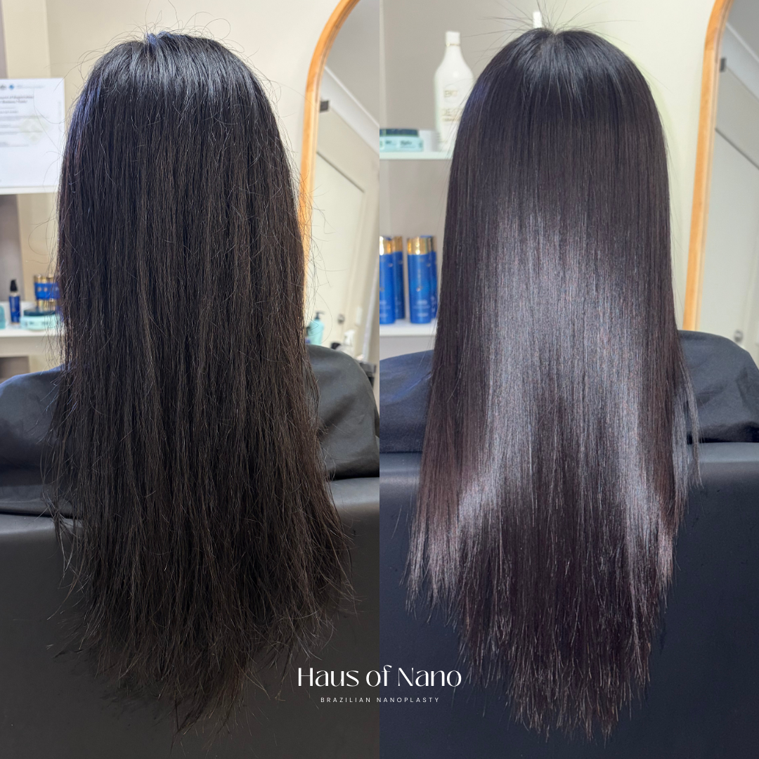 Before and after nanoplasty treatment 13