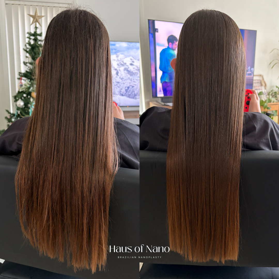 Before and after nanoplasty treatment 14