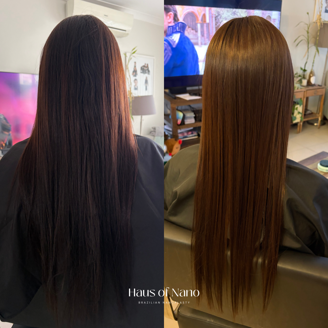 Before and after nanoplasty treatment 15