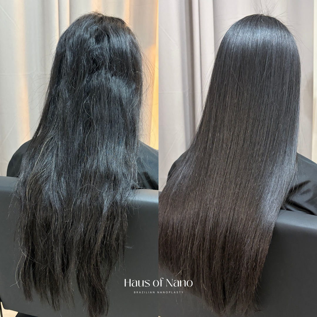 Before and after nanoplasty treatment 16
