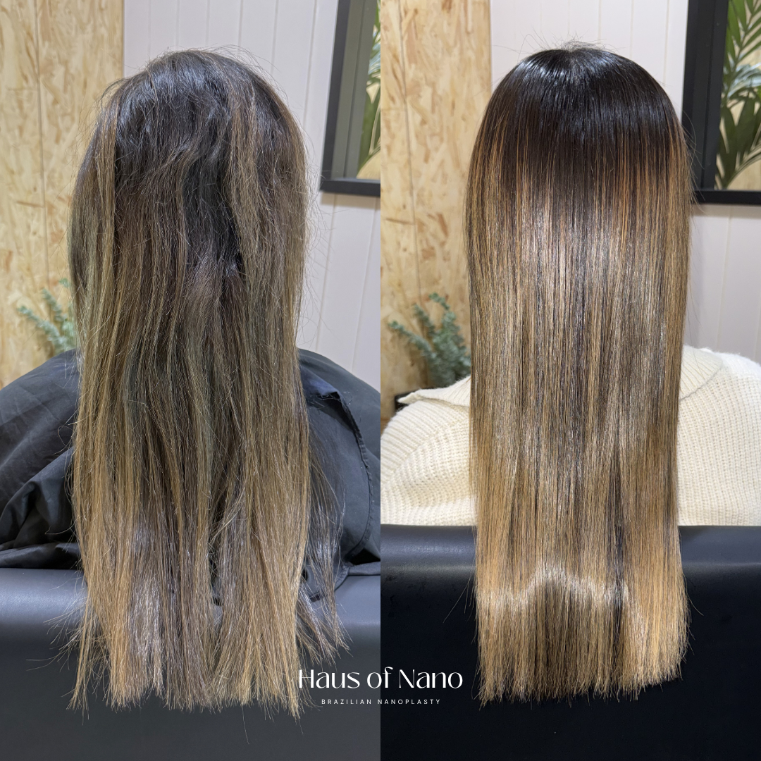 Before and after nanoplasty treatment 16