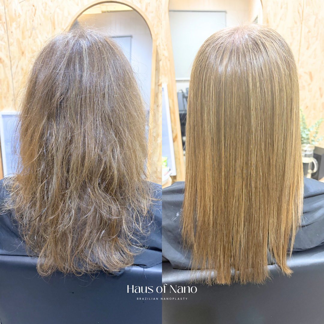 Before and after nanoplasty treatment 16