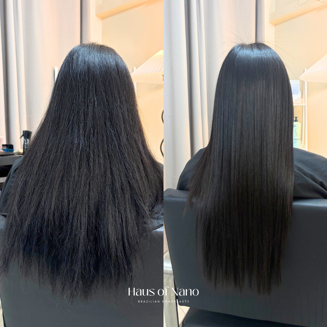 Before and after nanoplasty treatment 2