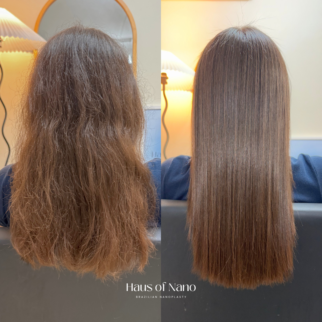 Before and after nanoplasty treatment 3
