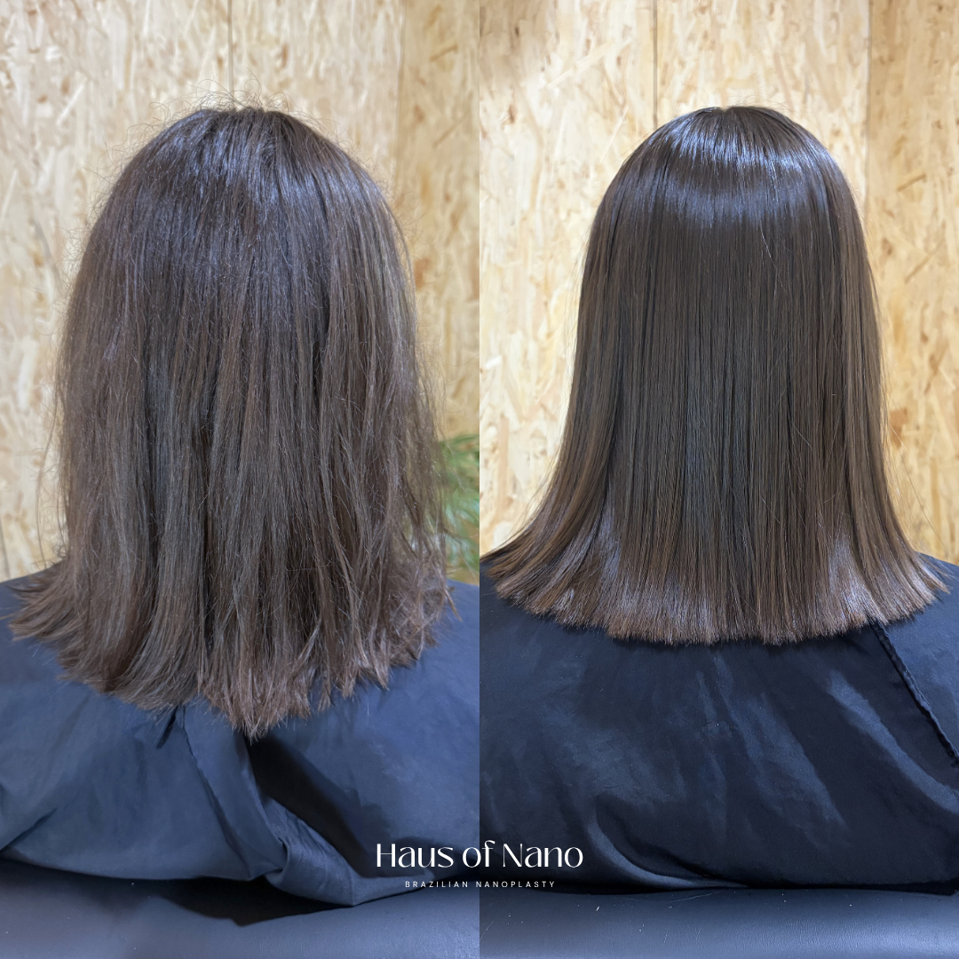 Before and after nanoplasty treatment 4