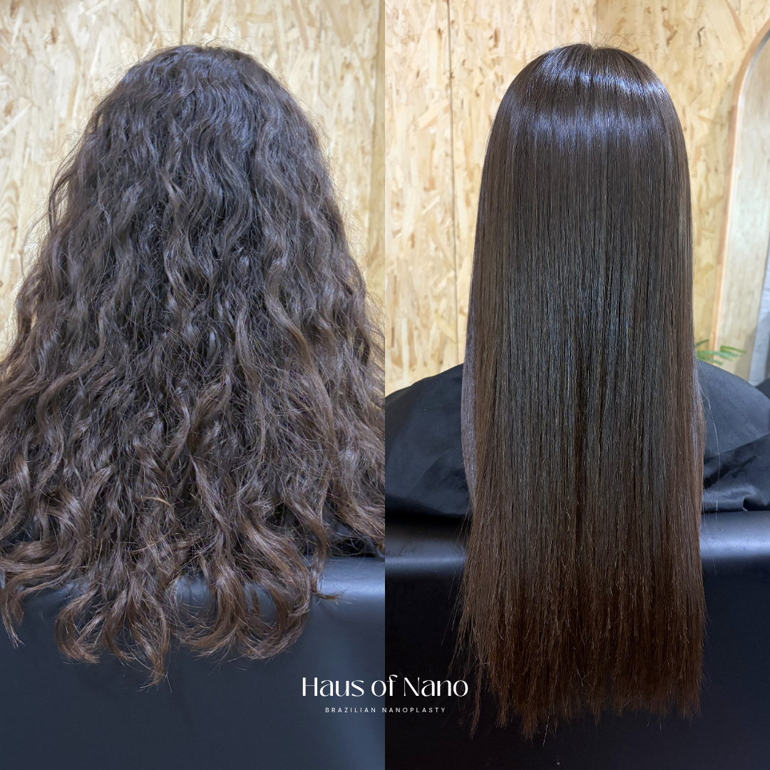 Before and after nanoplasty treatment 5
