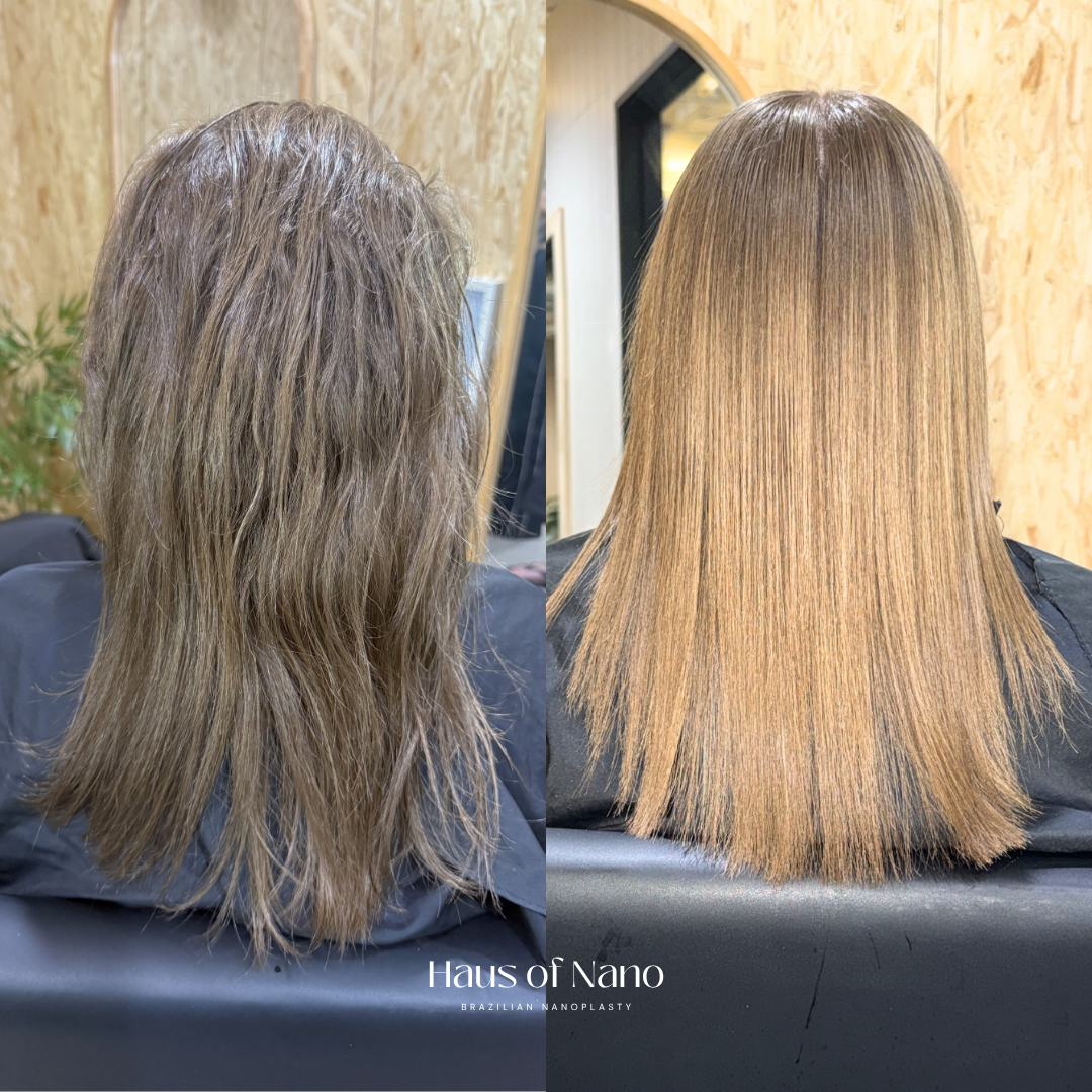 Before and after nanoplasty treatment 6