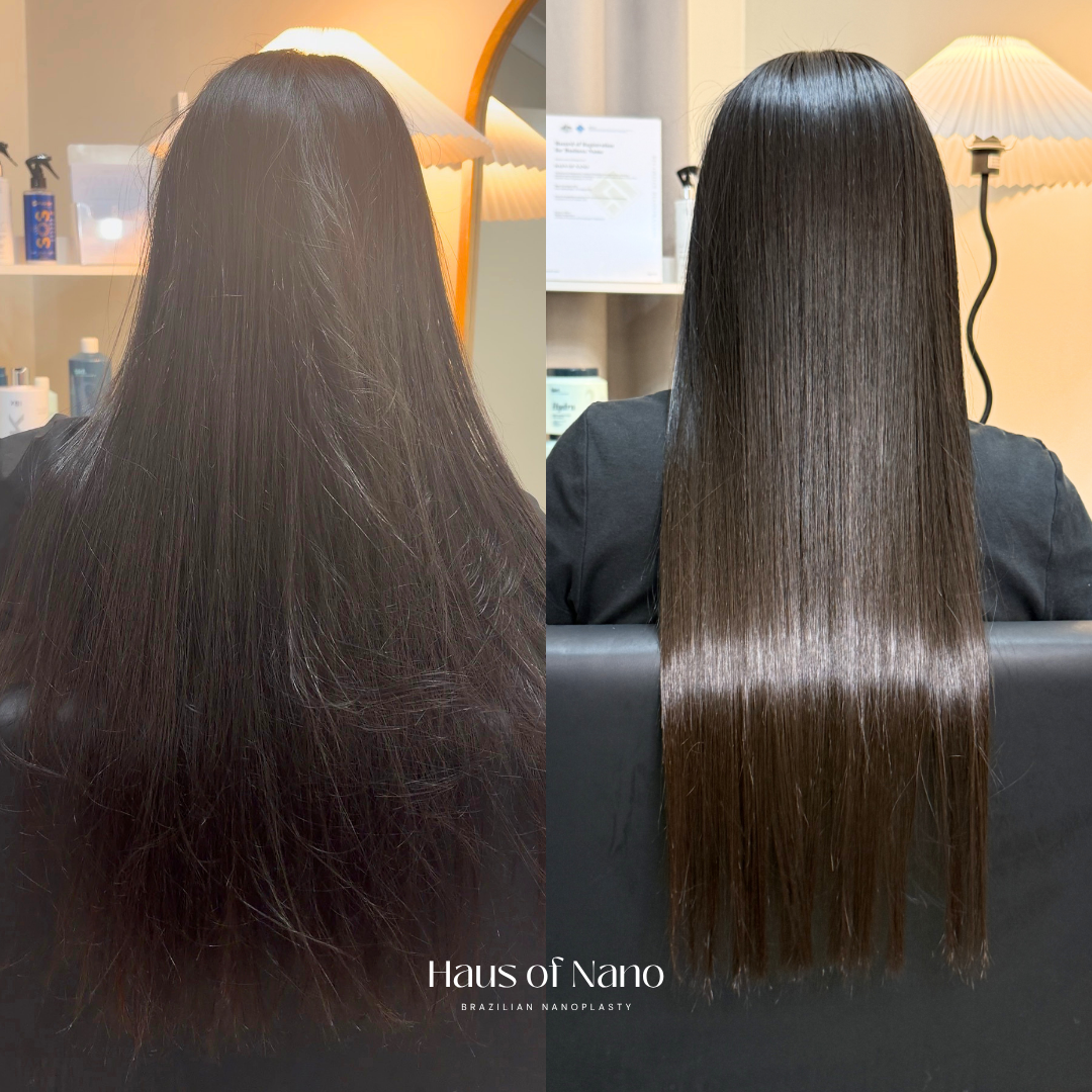 Before and after nanoplasty treatment 7