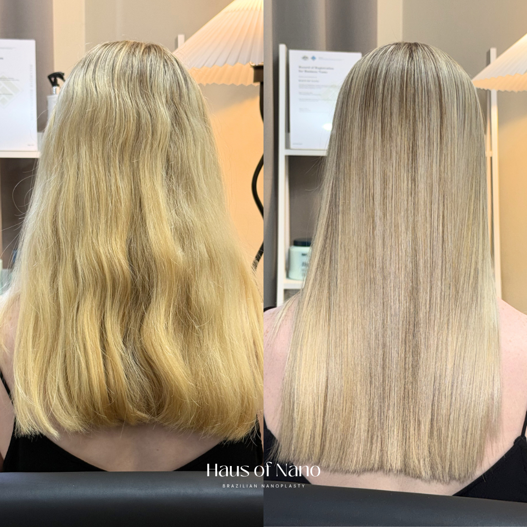 Before and after nanoplasty treatment 8