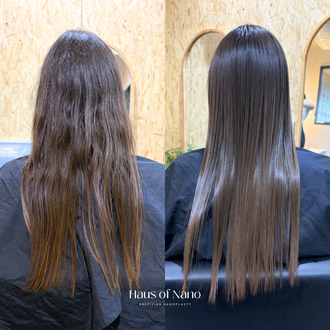 Before and after nanoplasty treatment 9